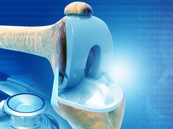 Joint Implant